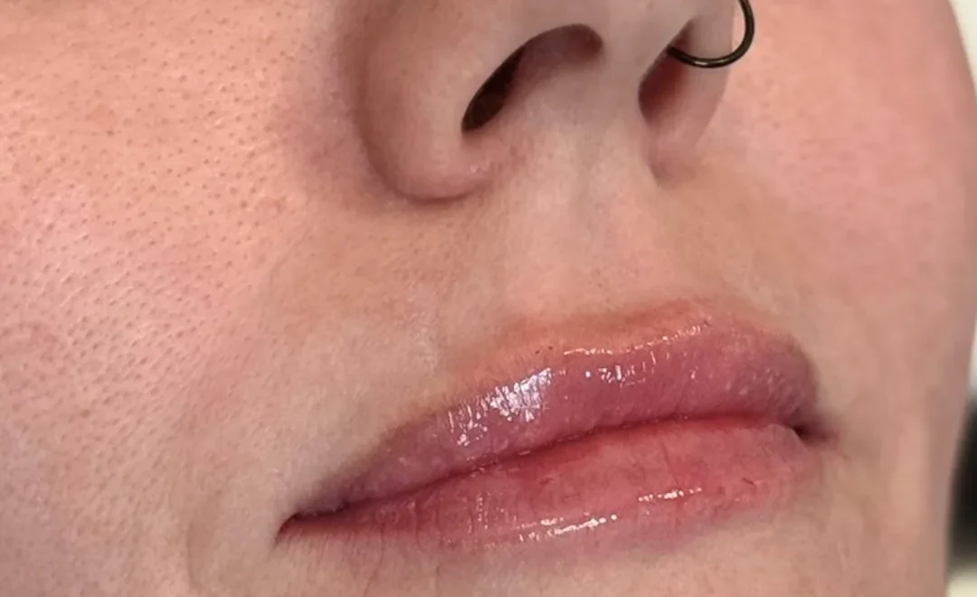 Lips after filler, natural plump