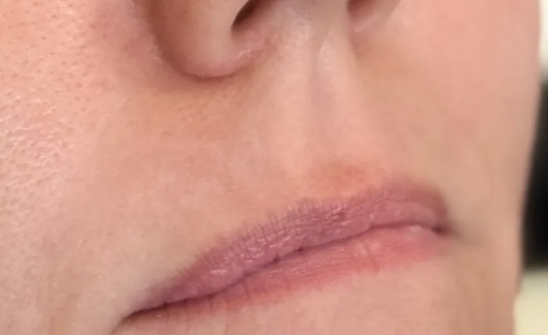 Lips before filler