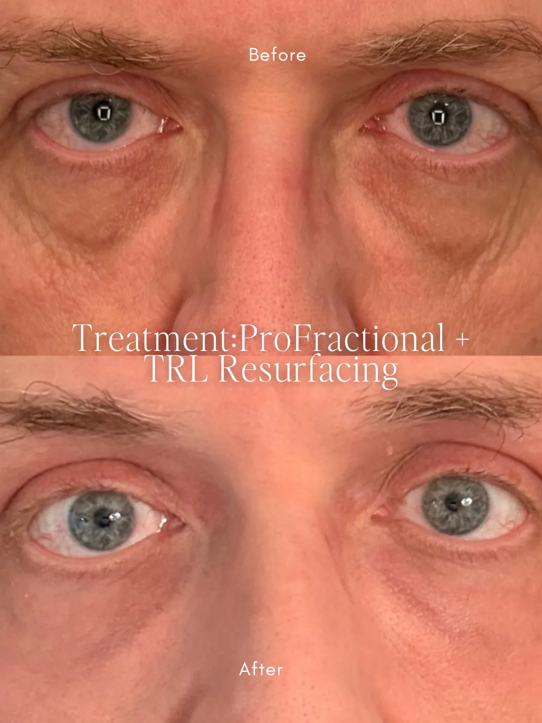 Under-eye before and after ProFractional and TRL resurfacing