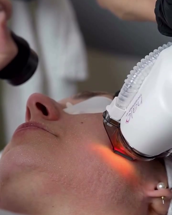 Sciton HALO TRIBRID handpiece delivering hybrid fractional laser resurfacing to a patient's cheek at Olympia Aesthetics in Palm Harbor, Florida
