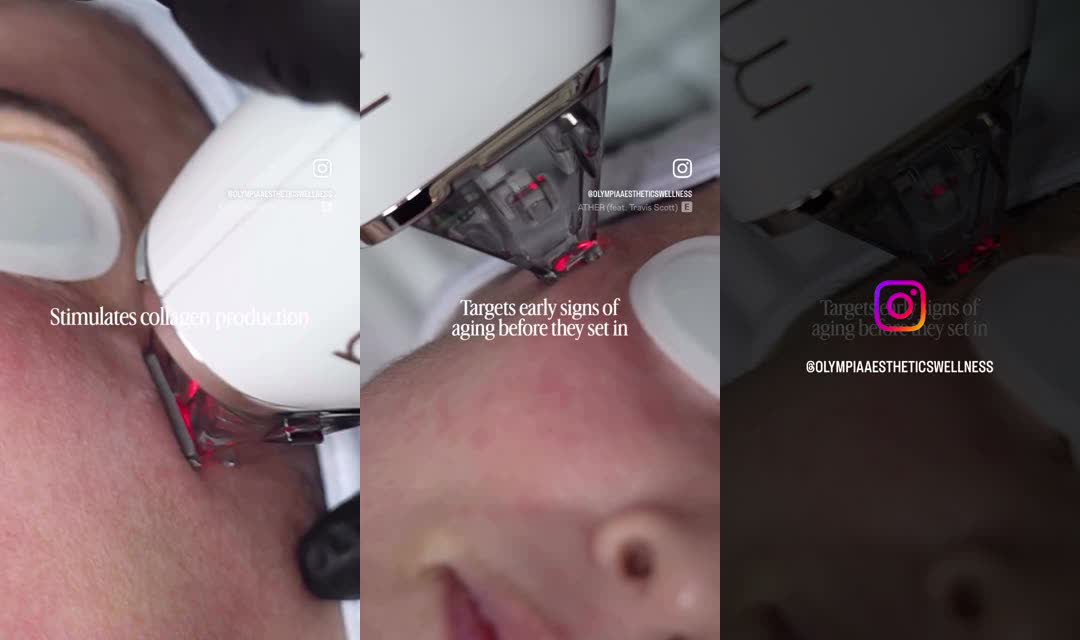 Fractional laser stimulating collagen production at Olympia Aesthetics in Palm Harbor