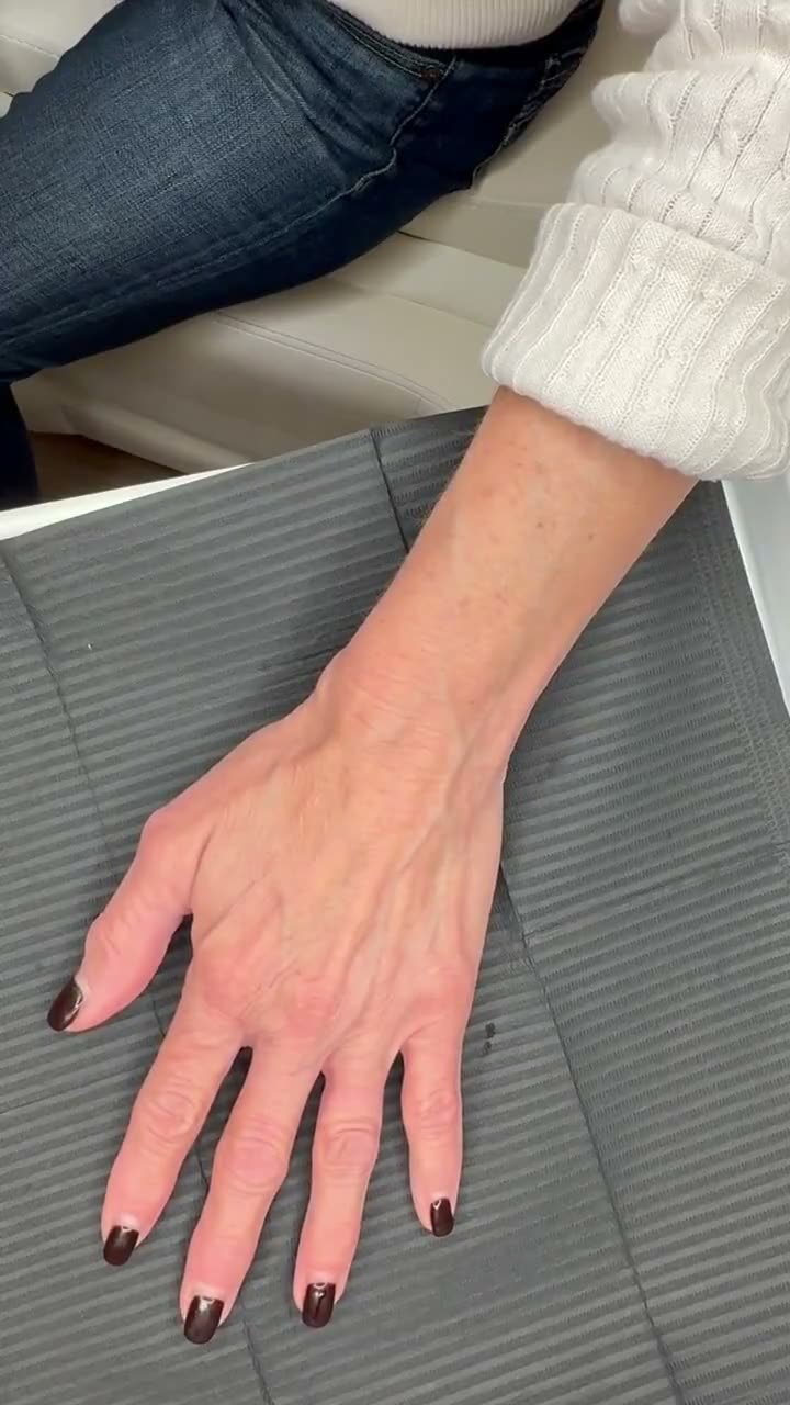 Olympia Morris, PA-C performing hyperdilute Radiesse hand rejuvenation at Olympia Aesthetics in Palm Harbor