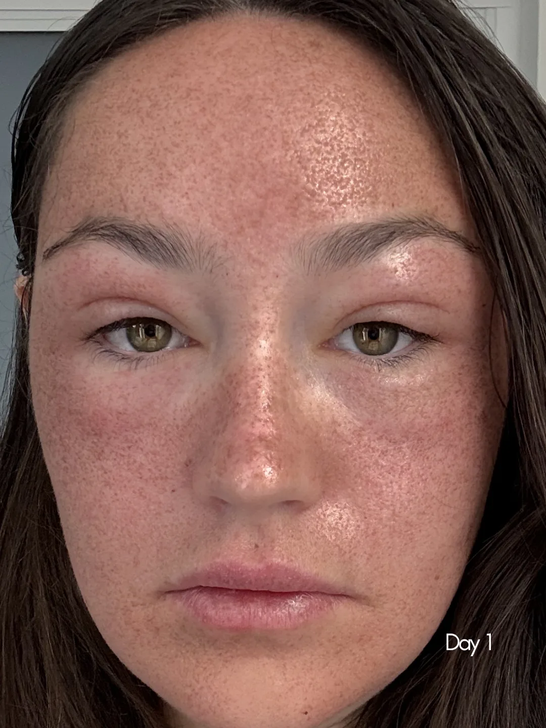 HALO TriBrid patient on day 1, treated melasma pigment darkened at the surface