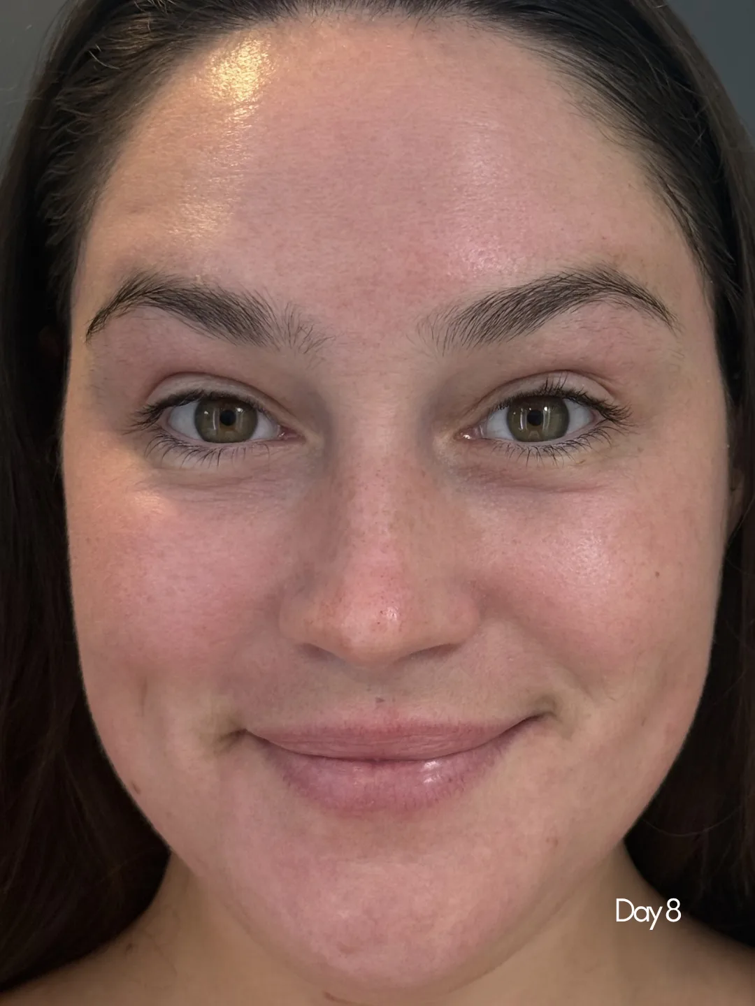 Same HALO TriBrid patient on day 8, clear even glowing skin