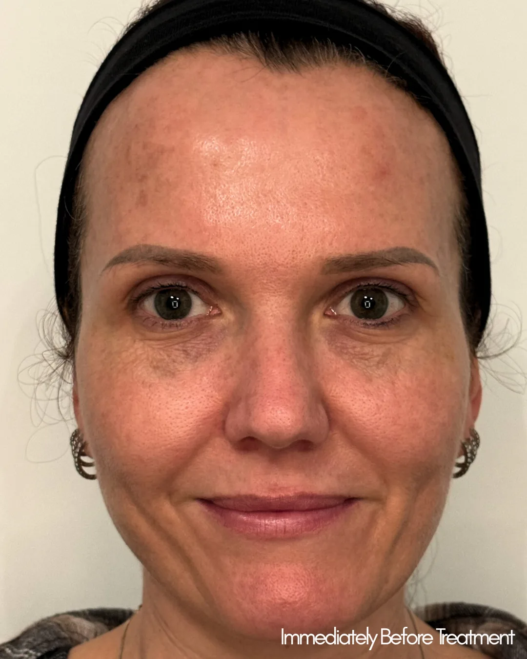 Patient before TRL laser resurfacing, with sun damage and wrinkles