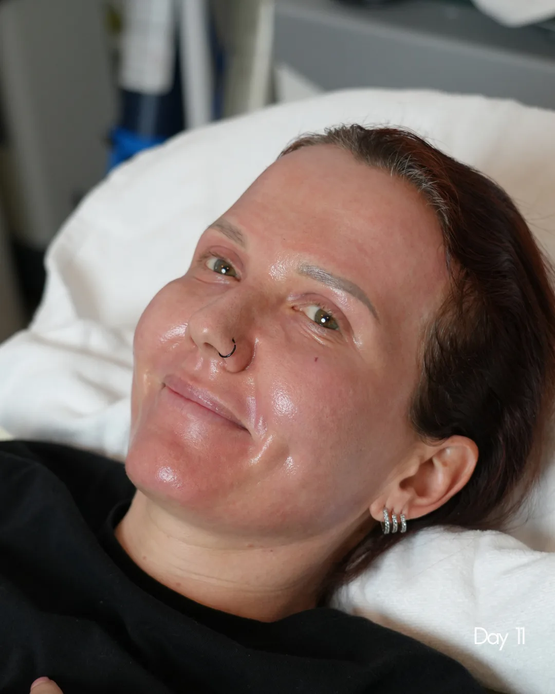 Same patient eleven days after TRL resurfacing, with clear glowing skin