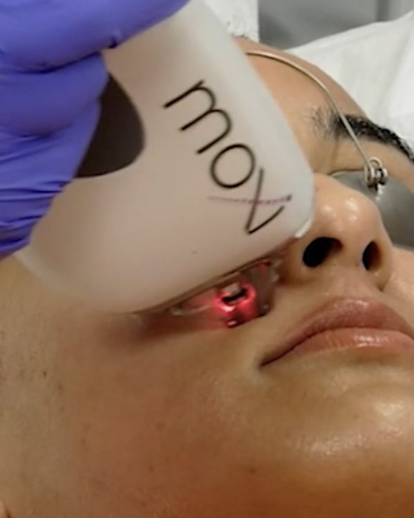 Sciton MOXI non-ablative fractional laser handpiece treating a patient's cheek at Olympia Aesthetics in Palm Harbor, Florida