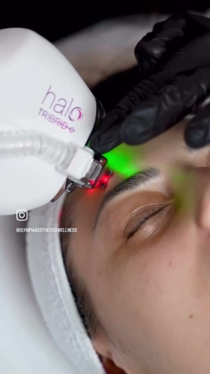 HALO TRIBRID handpiece firing red and green laser light during a treatment at Olympia Aesthetics in Palm Harbor, Florida