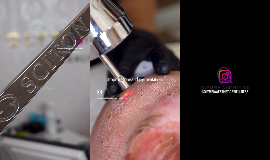 Sciton ProFractional erbium resurfacing in progress at Olympia Aesthetics in Palm Harbor