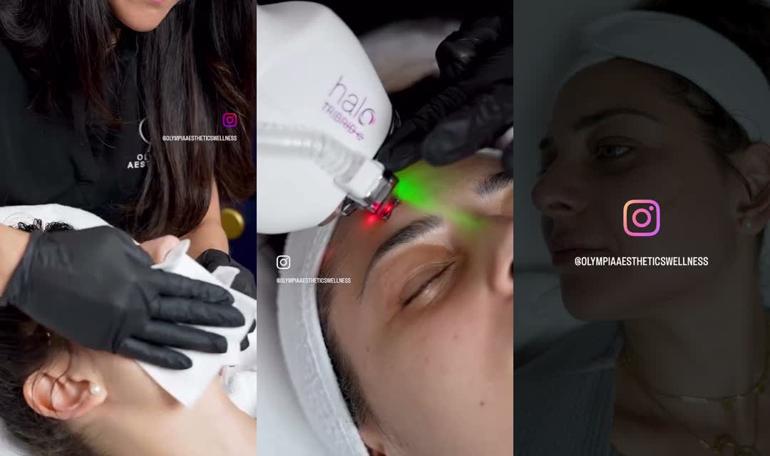 Sciton HALO TRIBRID resurfacing laser on a patient at Olympia Aesthetics