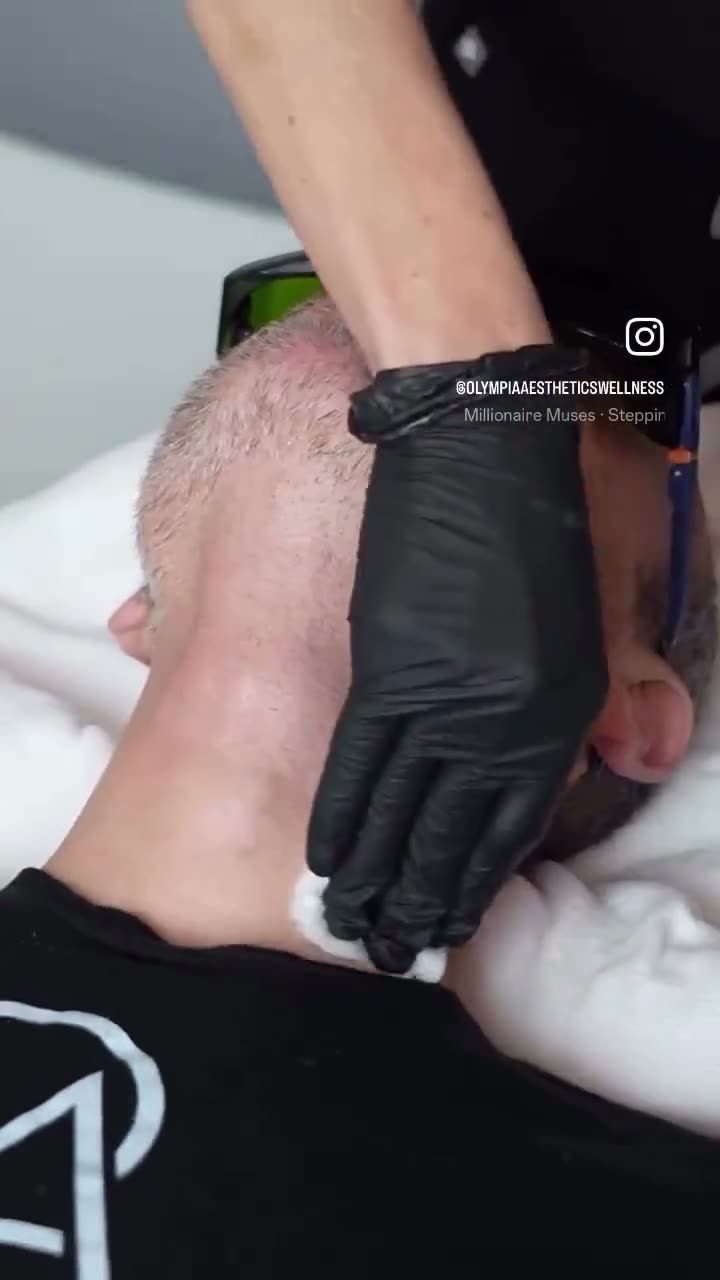Laser hair reduction on the neck of a male patient at Olympia Aesthetics in Palm Harbor