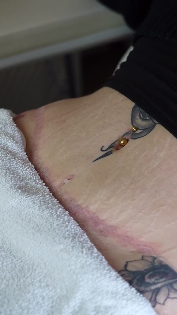 Olympia Morris, PA-C performing laser scar revision on a C-section scar at Olympia Aesthetics