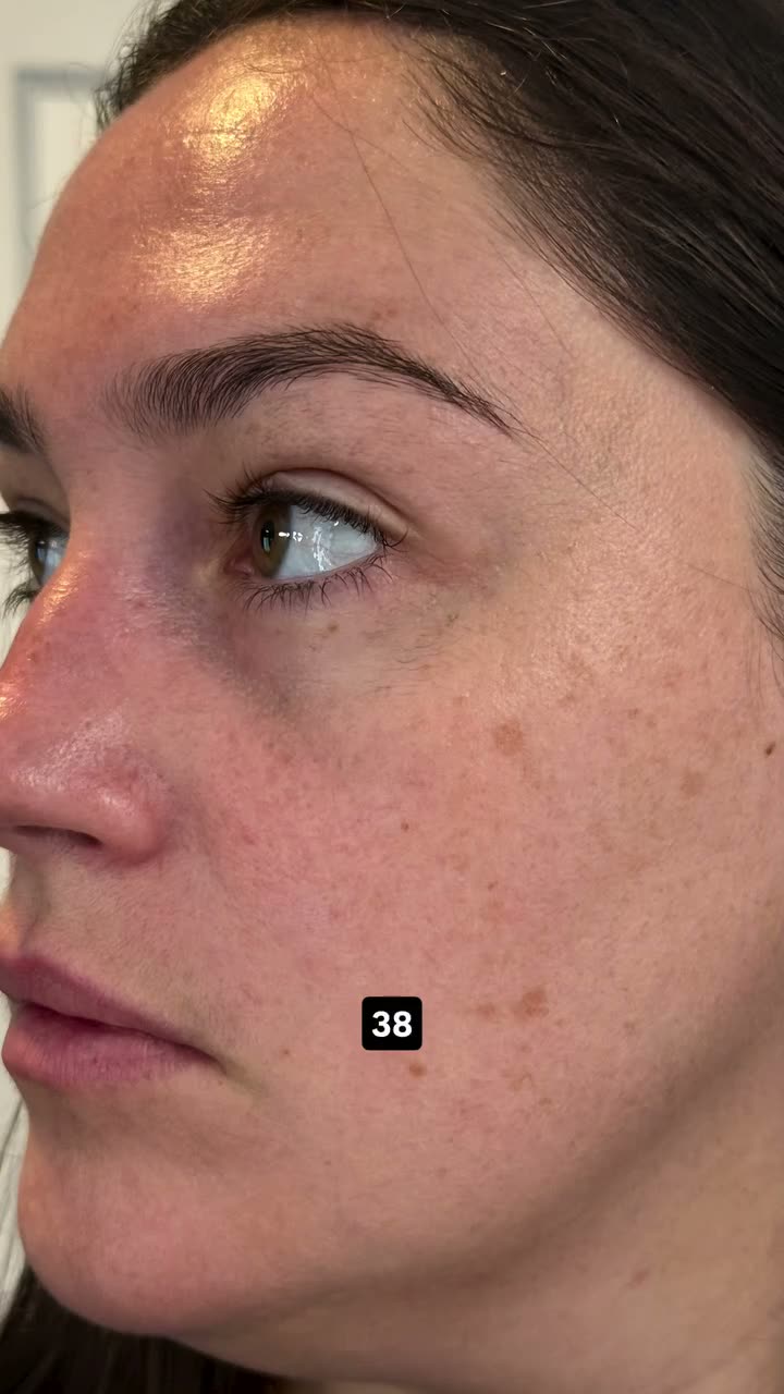 Tiffany, skin age 38 to 32, patient at Olympia Aesthetics & Wellness