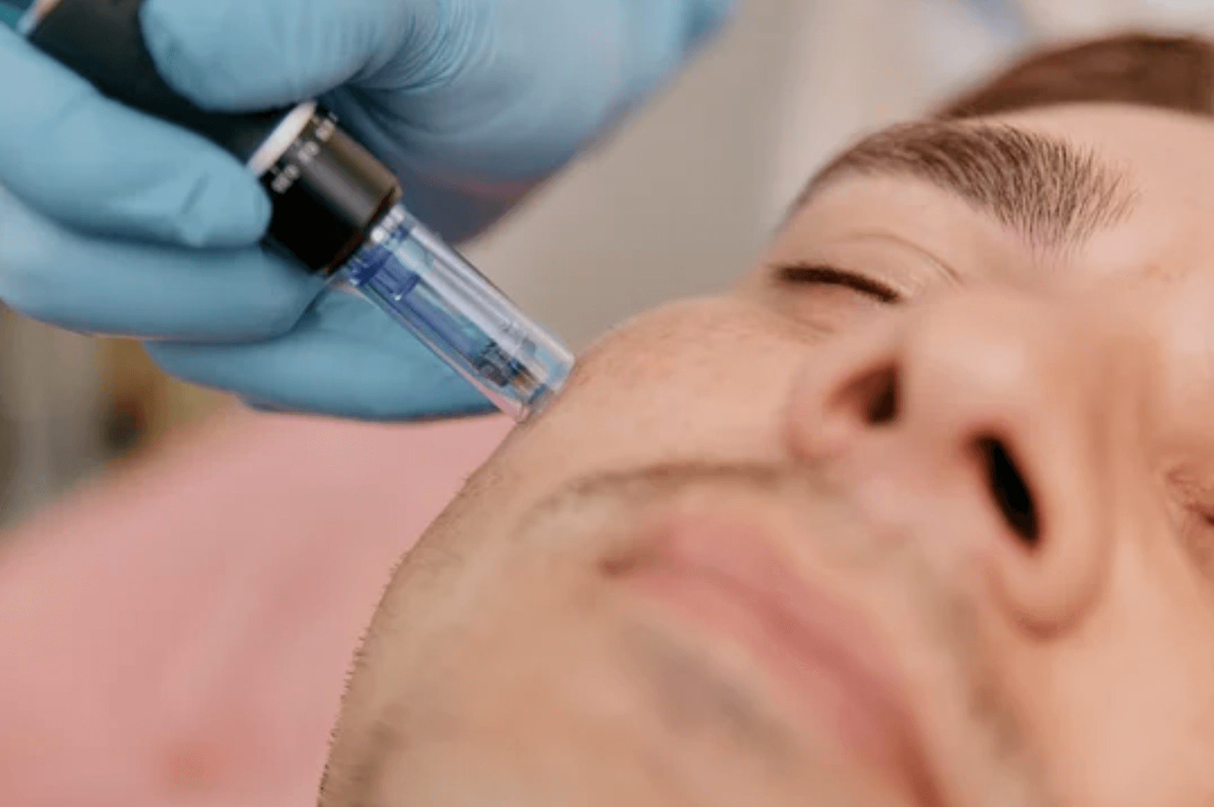 SkinPen microneedling treatment at Olympia Aesthetics in Palm Harbor, Florida