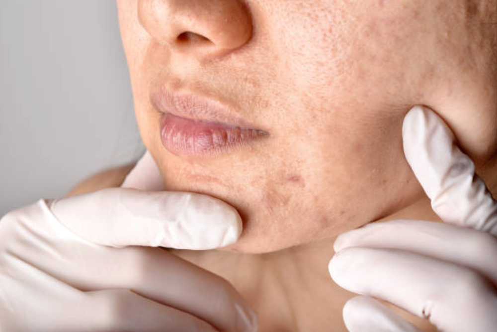 A doctor checking a woman's face seeing melasma