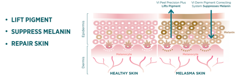 Skin layers and melasma