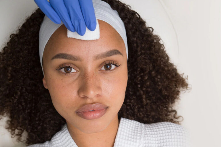 VI Peel treatment being applied to a woman’s forehead at Olympia Aesthetics for skin rejuvenation