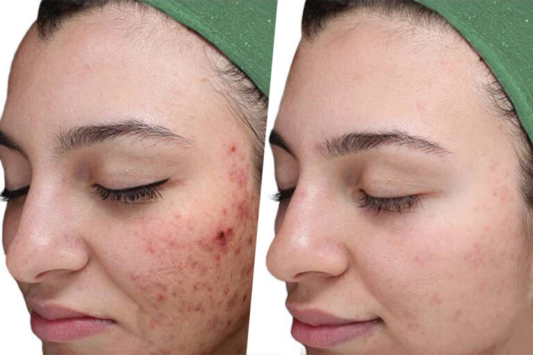 VI Peel treatment being applied to woman’s forehead for acne scars and skin rejuvenation