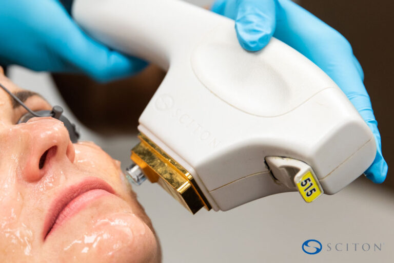 Close-up of a BBL procedure being performed on a patient’s face to improve skin tone and texture.