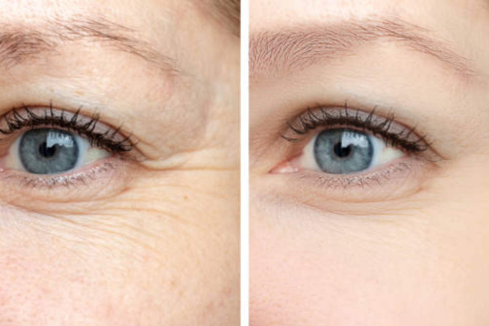 Close-up before and after results of TRL Laser Treatment, showing reduced wrinkles and smoother skin