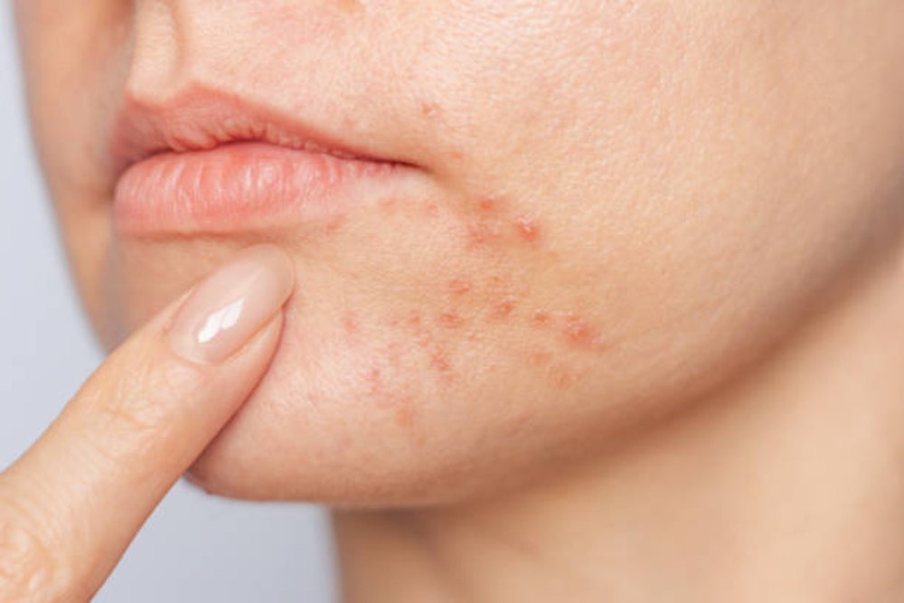 Close-up of adult female chin with active acne, illustrating skin concerns for acne prevention tips