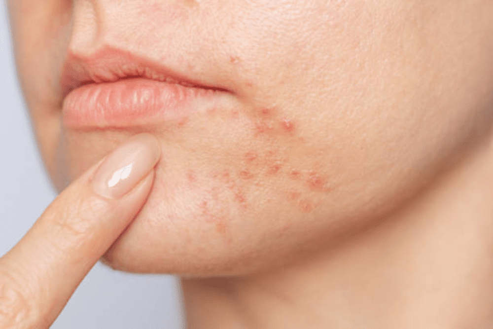 Close-up of adult female chin with active acne, illustrating skin concerns for acne prevention tips