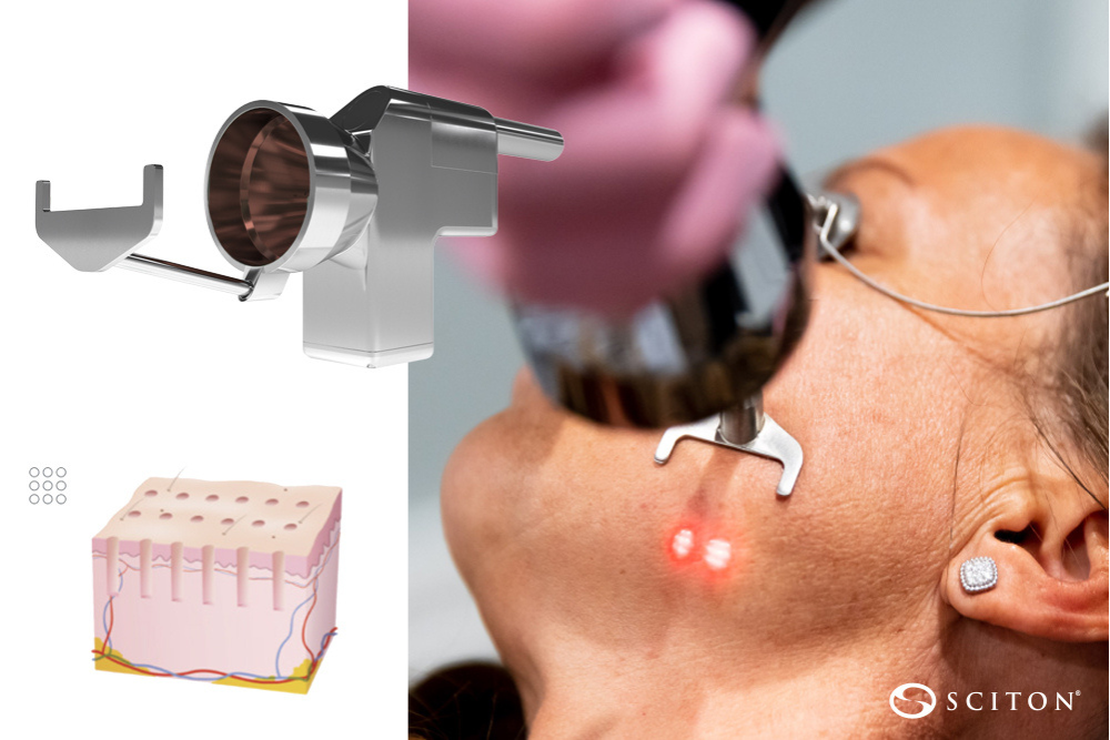 Sciton ProFractional laser handpiece used during facial treatment