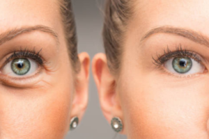 Before and after comparison of under-eye area, showing effective results of dermal fillers for dark circles and hollows.