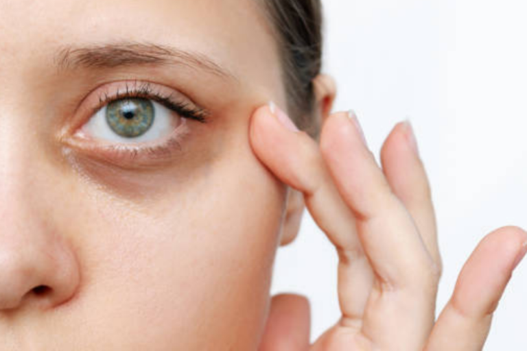 Woman gently touching under-eye area, considering dermal fillers for dark circles and hollows.