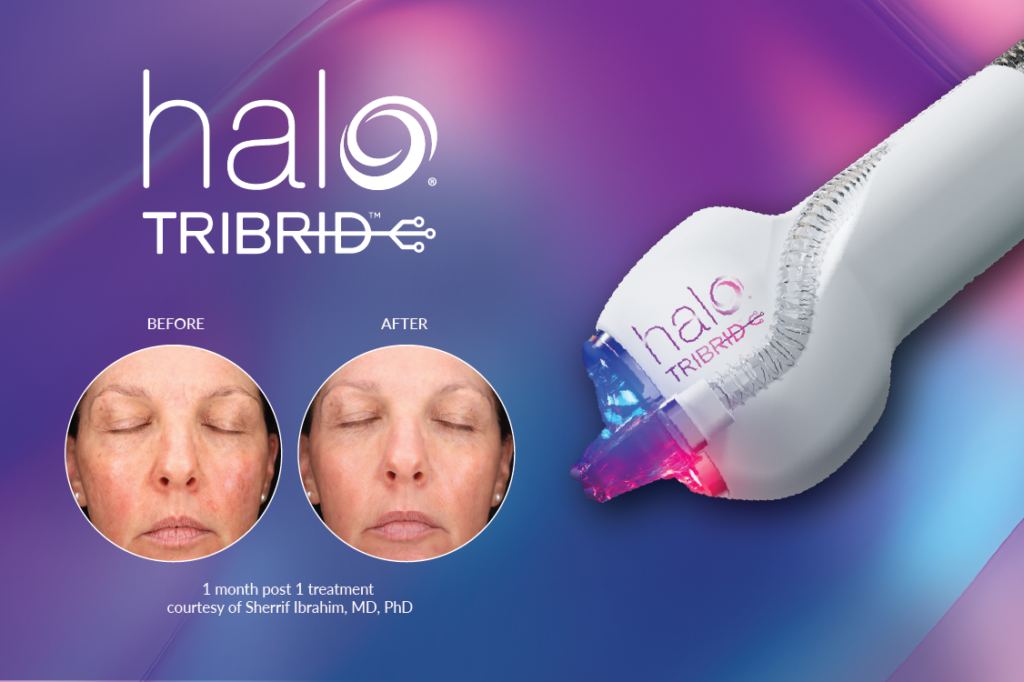 Sciton HALO Tribrid laser system used for advanced laser skin rejuvenation at Olympia Aesthetics and Wellness in Palm Harbor, Florida