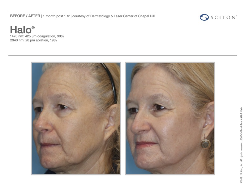 HALO laser before and after showing softened fine lines and fewer sun spots, courtesy of Sciton