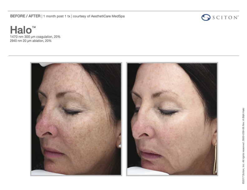 HALO laser before and after showing reduced sun damage, courtesy of Sciton