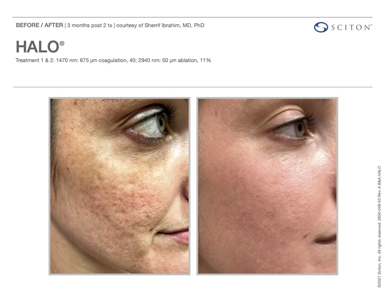 HALO laser before and after showing improved acne scarring, courtesy of Sciton
