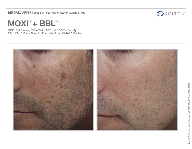 BBL HEROic before and after showing smoother, clearer skin, courtesy of Sciton