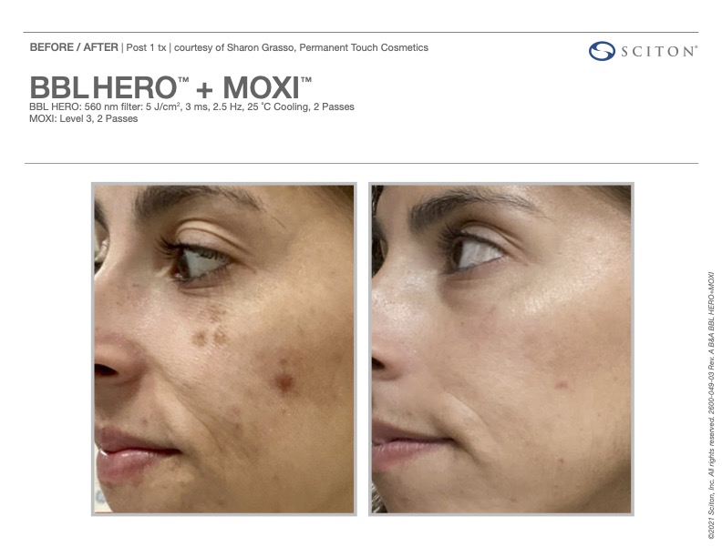 BBL HEROic before and after showing reduced pigmentation and sun spots, courtesy of Sciton