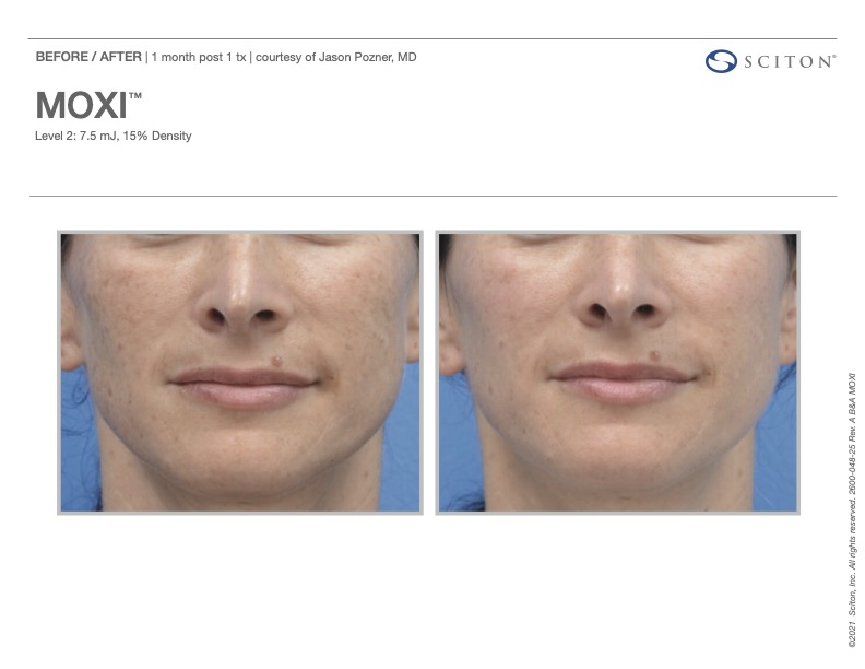 MOXI laser before and after showing brighter, clearer skin, courtesy of Sciton