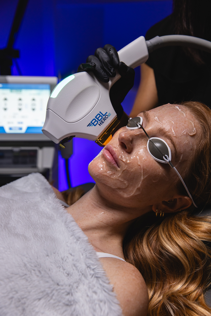 Sciton image of patient undergoing a BBL treatment now available at Olympia Aesthetics in Palm Harbor Florida.
