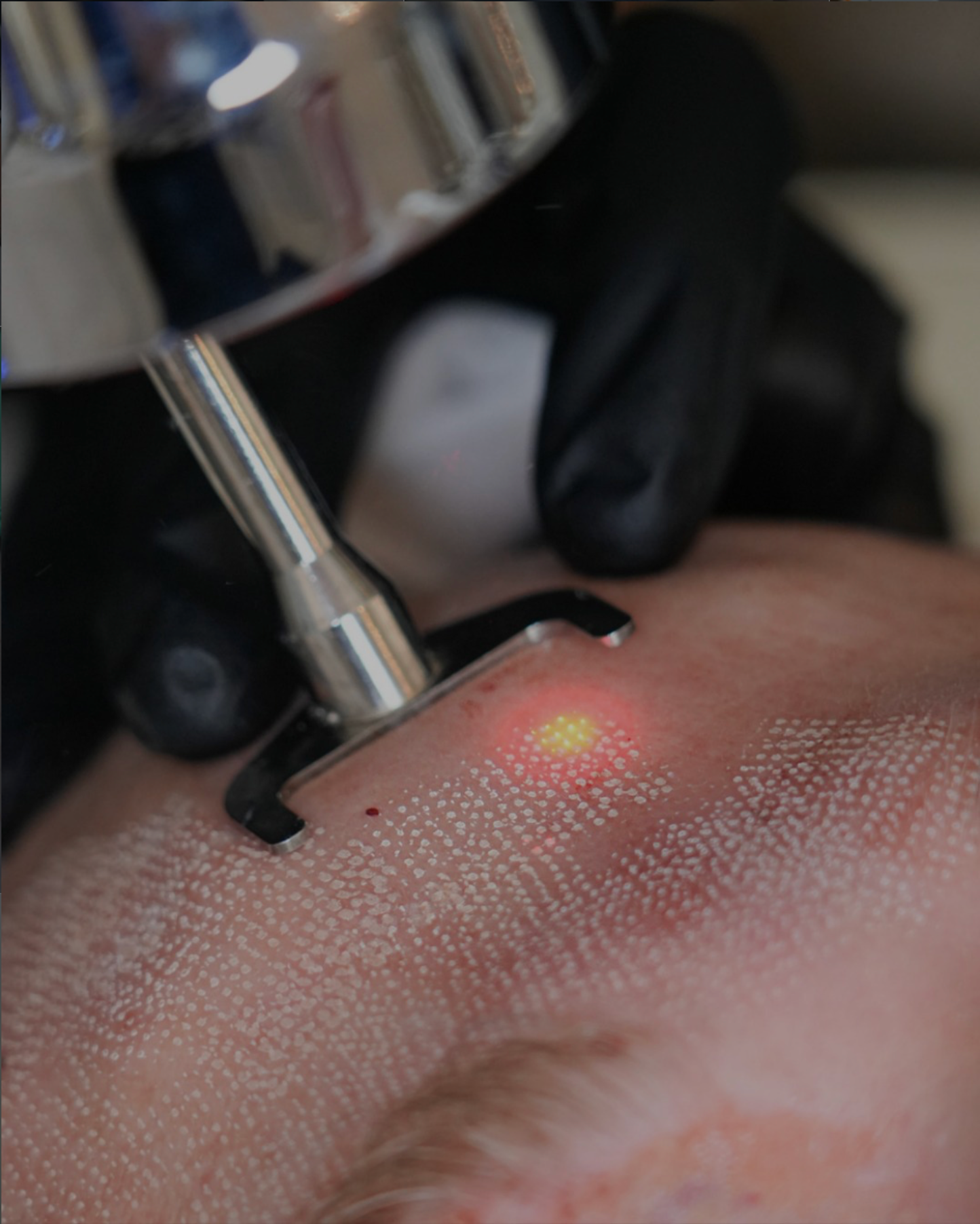 Close-up Sciton laser treatment at Olympia Aesthetics in Palm Harbor, Florida