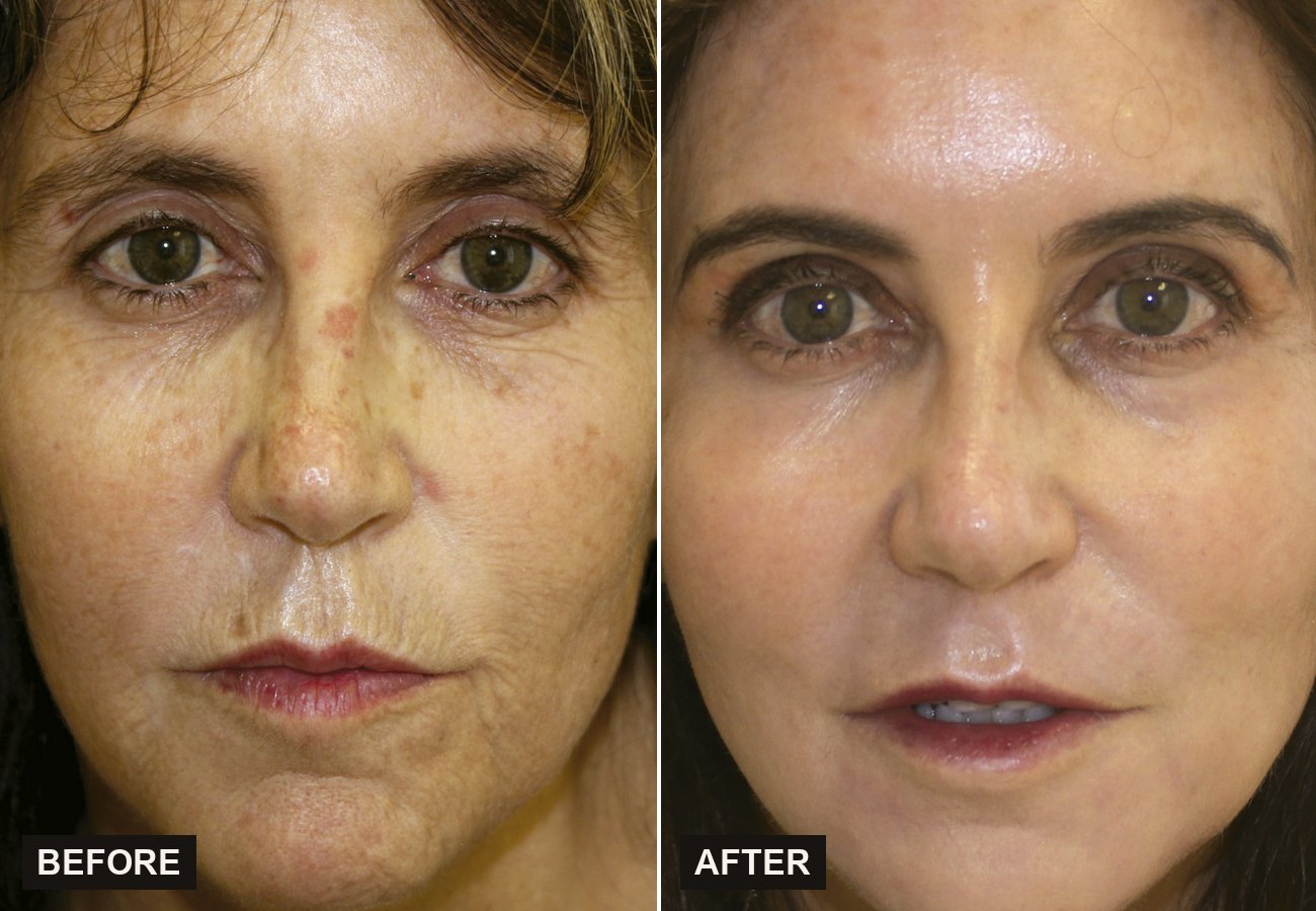 Before and after Sciton BBL HEROic improving sun damage and uneven tone at Olympia Aesthetics in Palm Harbor