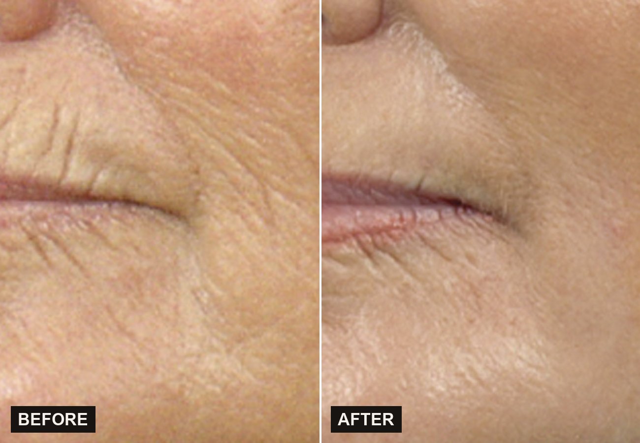 Before and after Sciton BBL HEROic improving clarity and smoothness at Olympia Aesthetics
