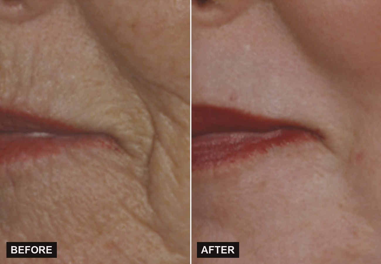 Before and after Sciton ProFractional softening etched lines around the mouth at Olympia Aesthetics