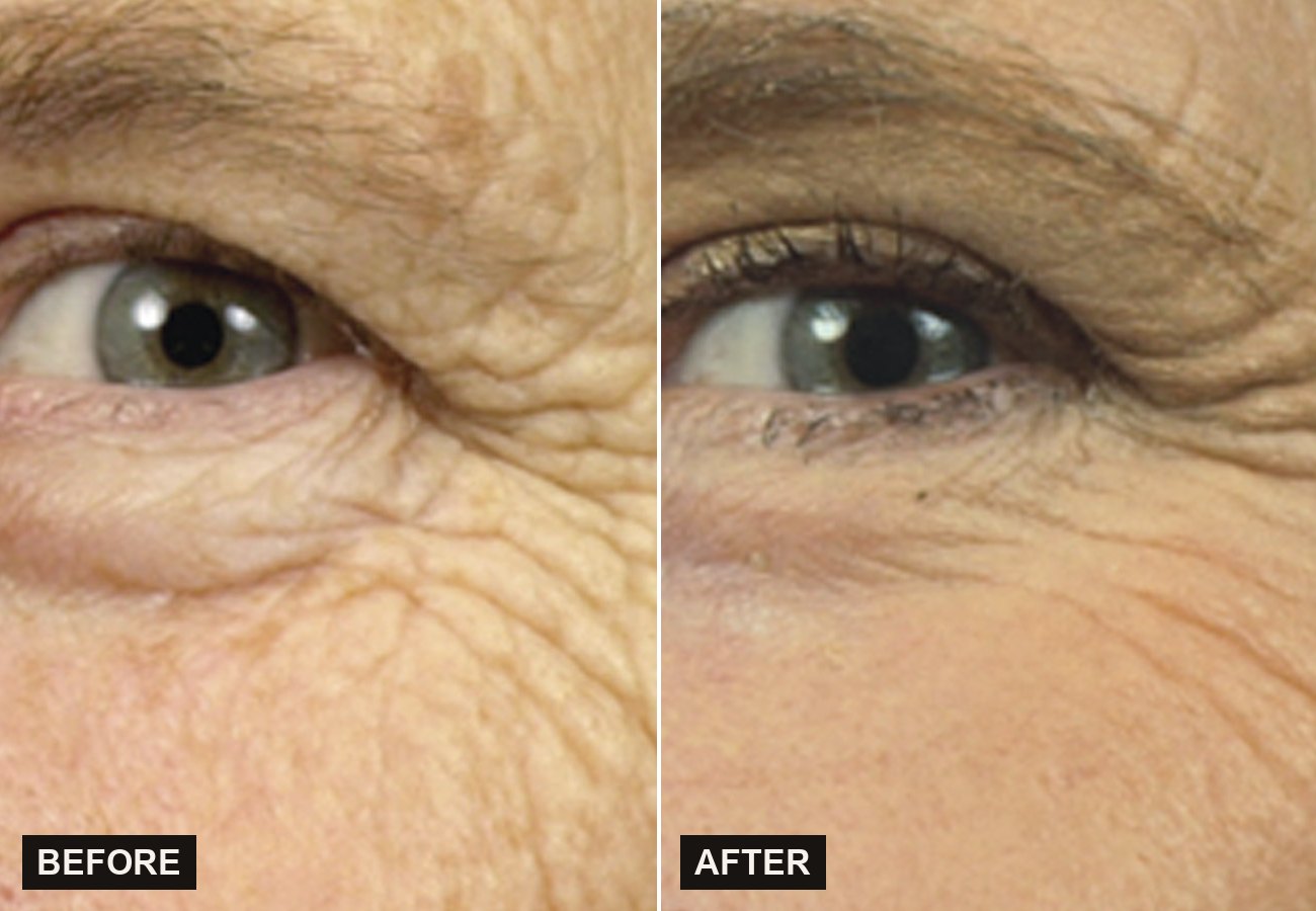 Before and after Sciton ProFractional improving fine lines around the eyes at Olympia Aesthetics