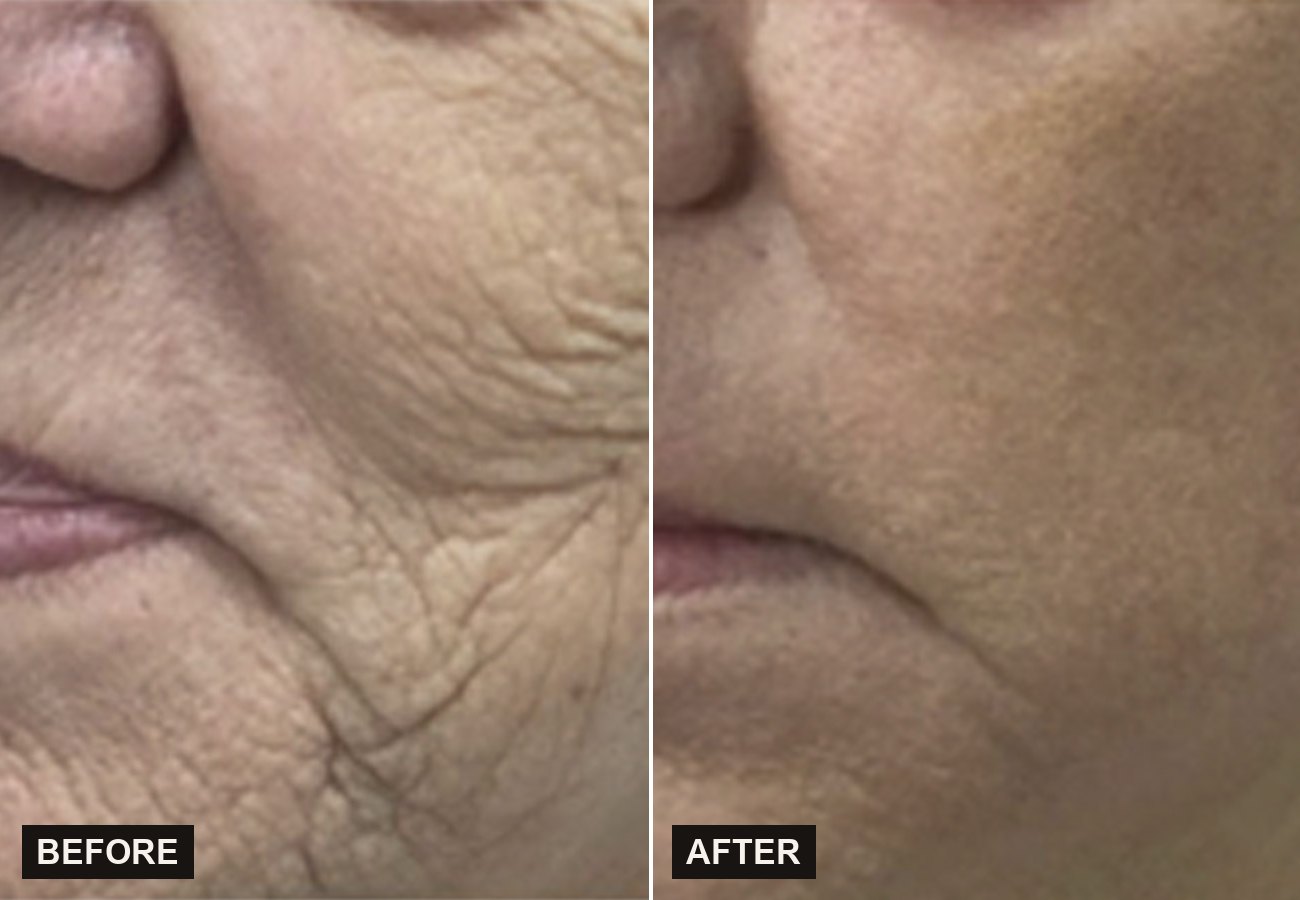 Before and after Sciton ProFractional improving texture and acne scarring at Olympia Aesthetics