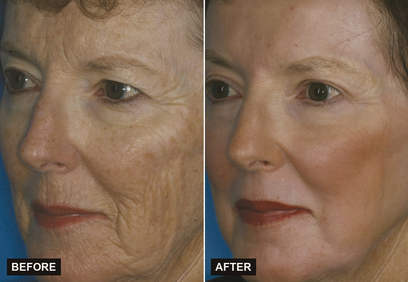 Before and after Sciton Contour TRL for deep wrinkles and sun damage at Olympia Aesthetics in Palm Harbor