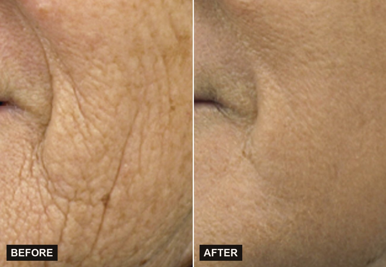 Before and after Sciton Contour TRL improving texture and smoothness at Olympia Aesthetics