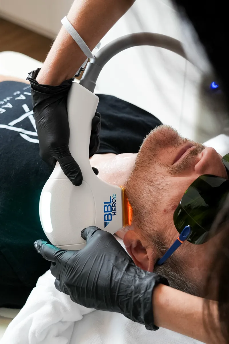 Sciton BBL HEROic treating the jaw and neck of a male patient at Olympia Aesthetics in Palm Harbor