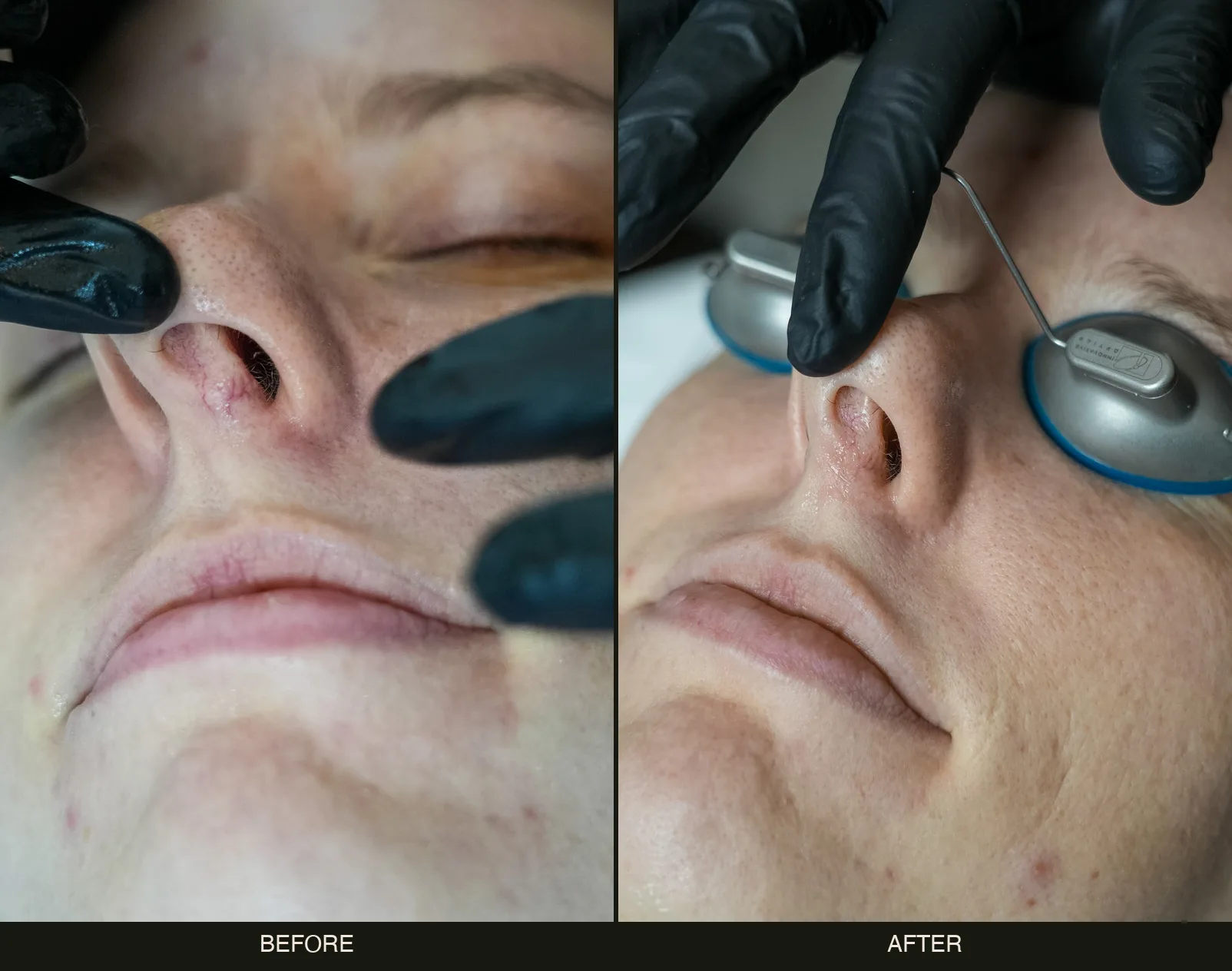 Before and after treatment of nasal spider veins on an actual Olympia Aesthetics patient in Palm Harbor