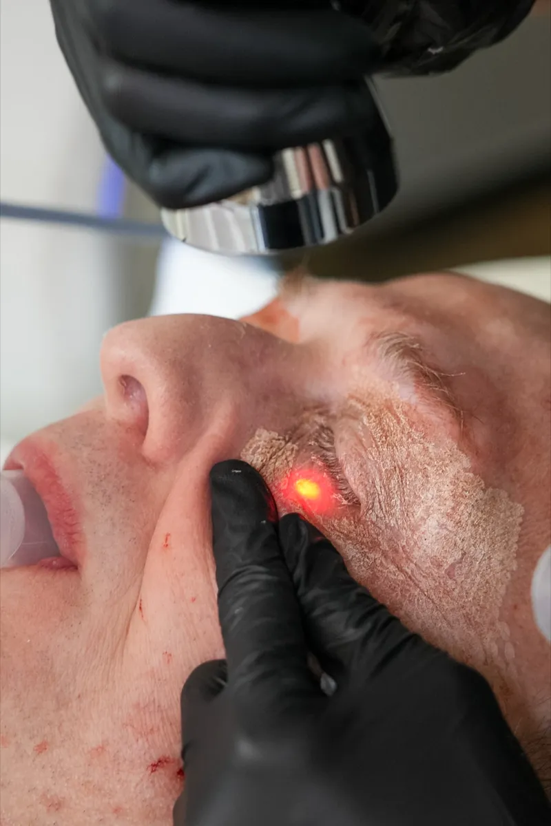 Sciton Contour TRL treating fine lines around the eyes of a male patient at Olympia Aesthetics in Palm Harbor
