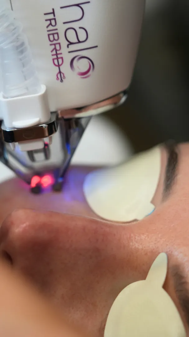 The Sciton HALO handpiece treating a patient's skin at Olympia Aesthetics in Palm Harbor