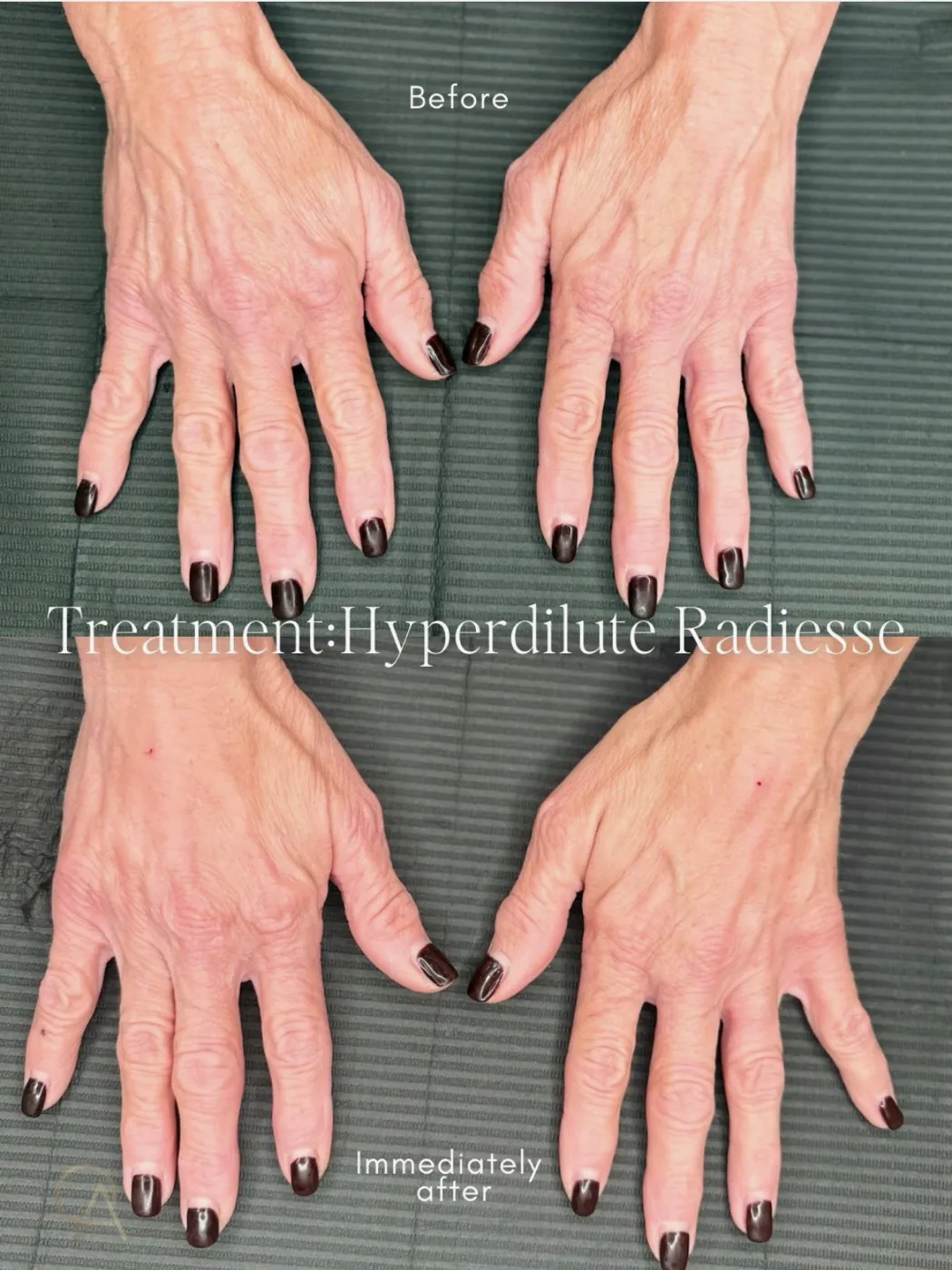 Before and immediately after hyperdilute Radiesse hand rejuvenation on an actual Olympia Aesthetics patient